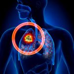 lung cancer link to parasites