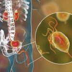 prostate cancer link to parasites